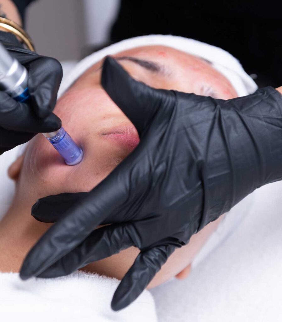 Microneedling is a great treatment that helps skin rejuvenation - Come To Dermaluxe Spa Today for Microneedling - Are You Looking for Skin Rejuvenation in Houston Then Microneedling from Dermaluxe Spa is the place to come