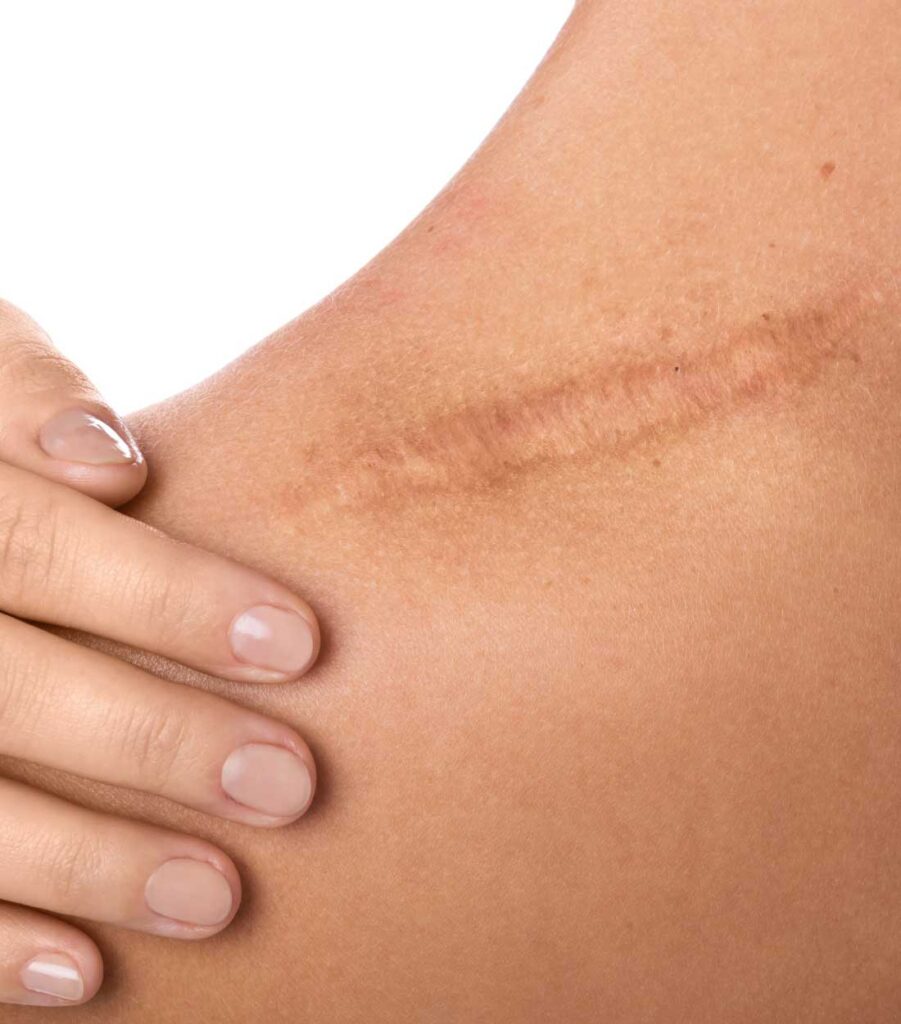 Best Scar Camouflage in Houston Texas - Come To Dermaluxe Spa today to get your unwanted scars taken care of - Restore your skins beauty at Dermaluxe Spa in Houston Today