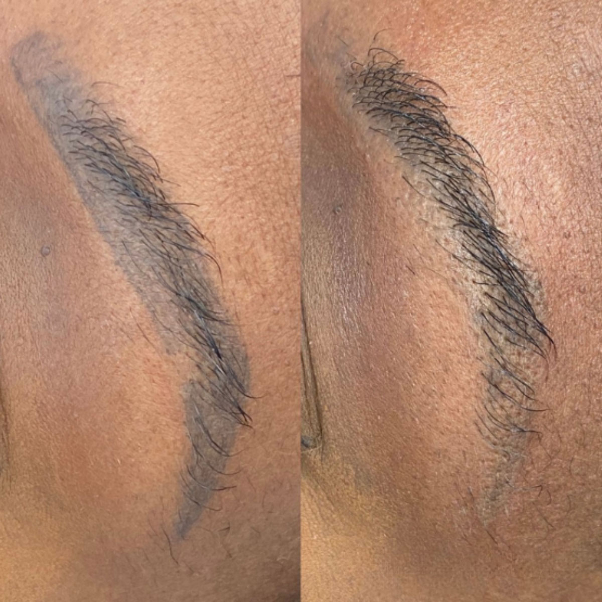 Dark Skin Microblading Removal in Houston - Dermaluxe Spa