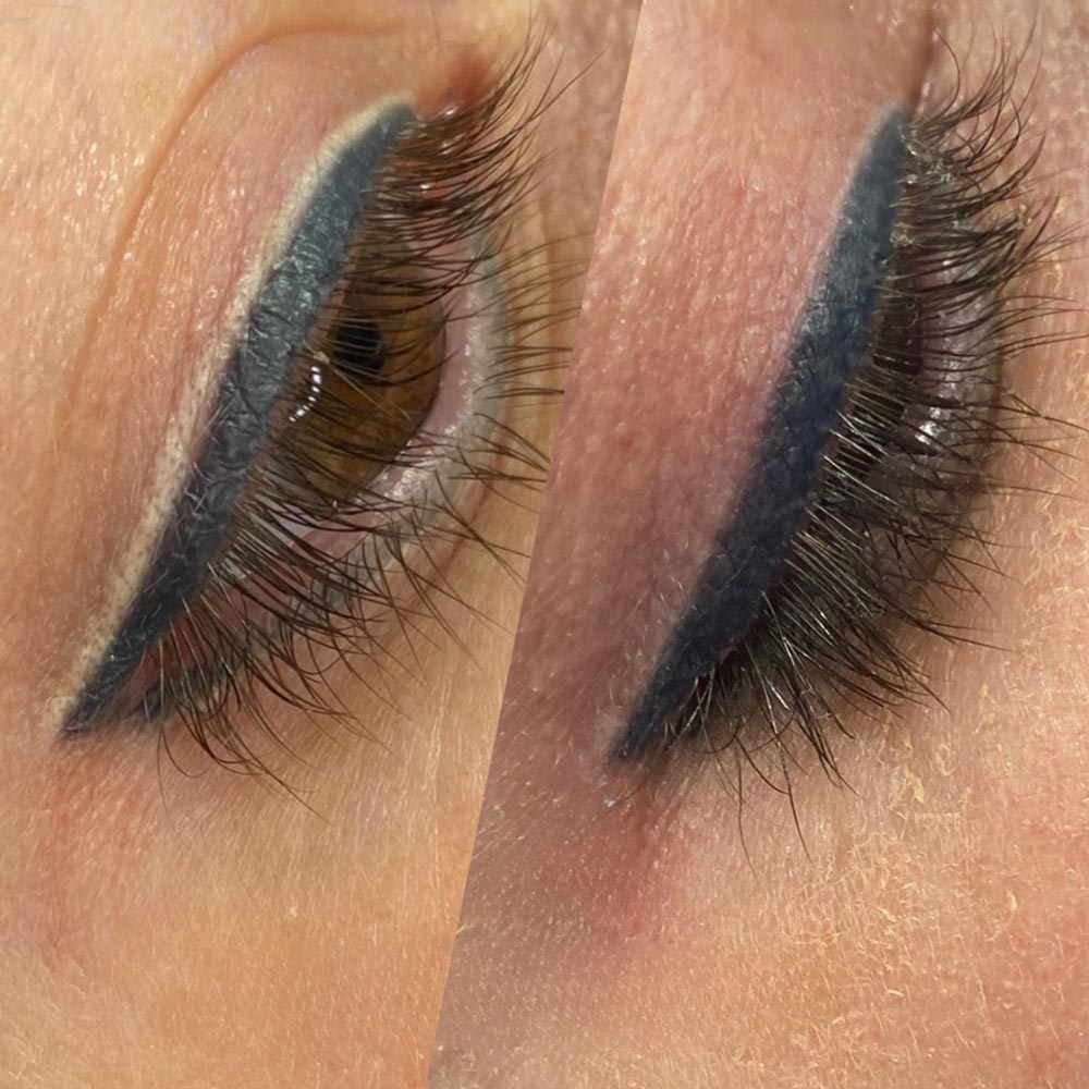 Permanent Eyeliner Removal Houston - Laser Eyeliner Removal-Dermaluxe Spa - Visit Dermaluxe Spa in Houston Today for The Best Permanent Eyeliner Removal
